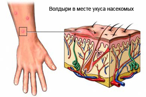 allergija-na-komarov