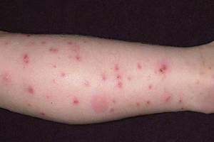 simptomi-ykysa-komara54645
